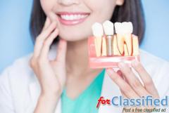How Long Do Dental Implants Last?