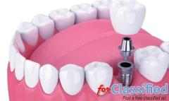When to Consider Dental Implants: Exploring Options for Tooth Replacement