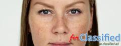 Pigmentation Treatment in Ludhiana