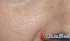 Open Pores Treatment in Ludhiana