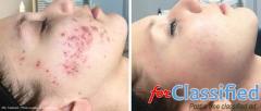 IPL (Intense Pulsed Light) - Mid Florida Dermatology & Plastic Surgery